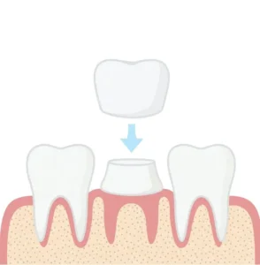Corona Dentale Albania